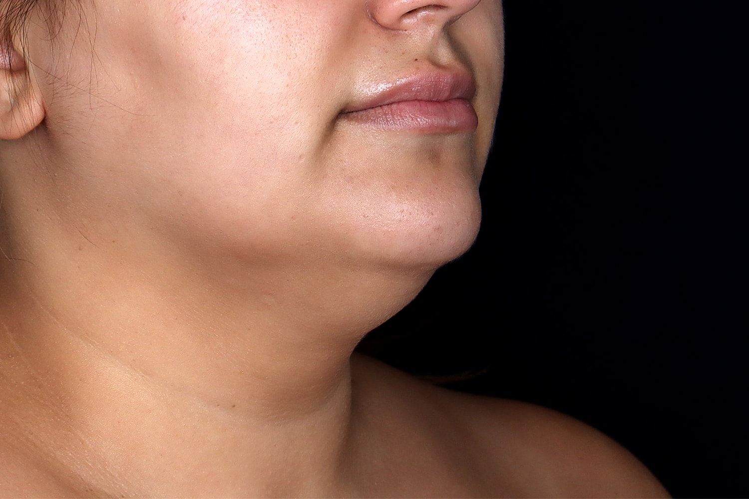 Chin Liposuction Before & After
