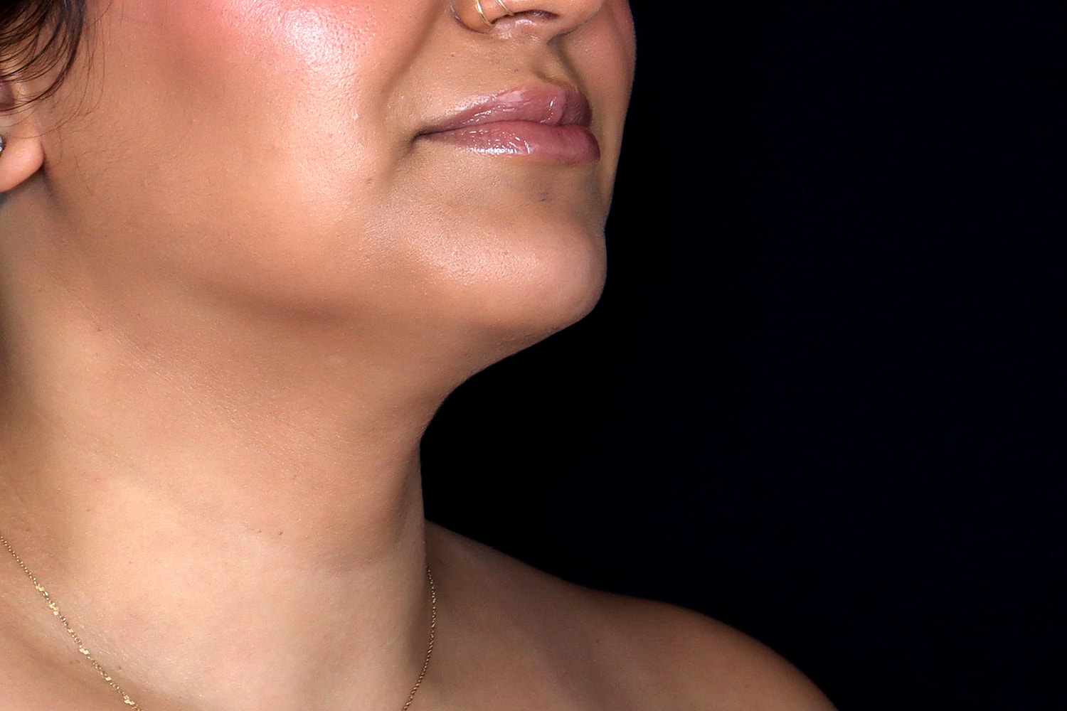 Chin Liposuction Before & After