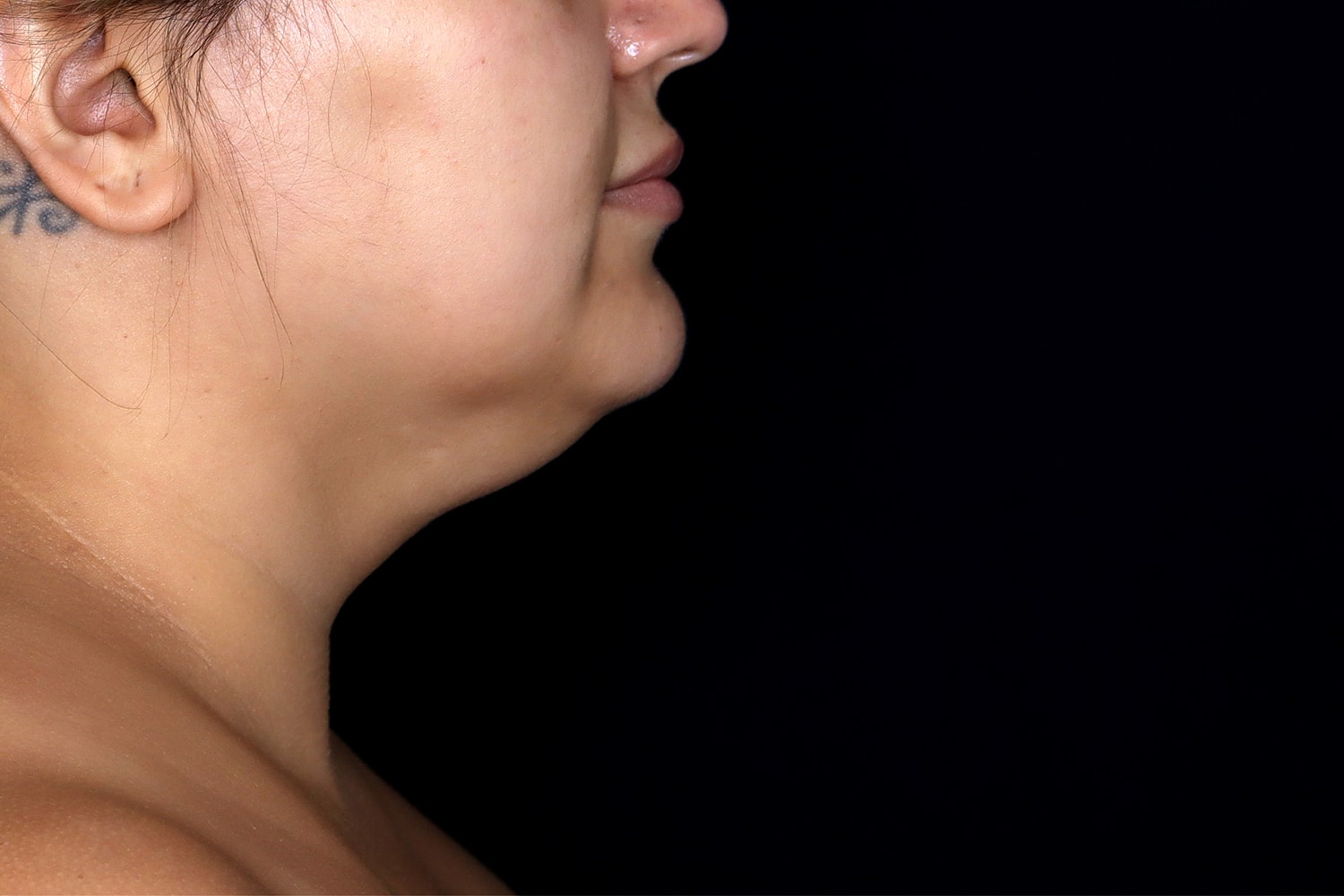 Chin Liposuction Before & After