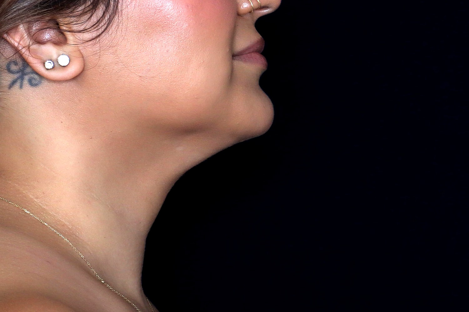 Chin Liposuction Before & After