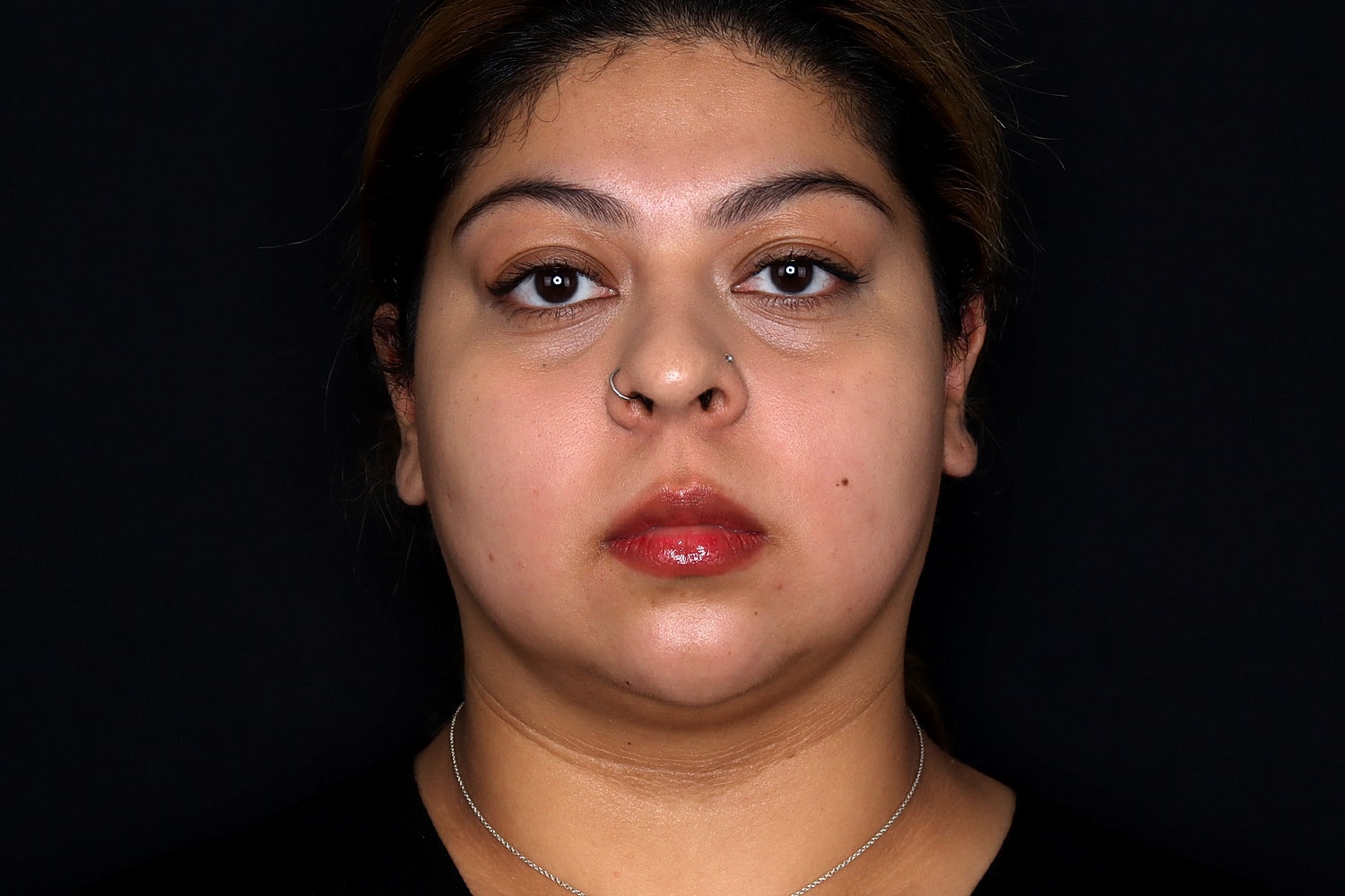 Chin Liposuction Before & After