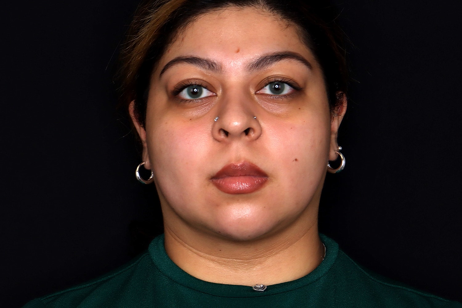Chin Liposuction Before & After