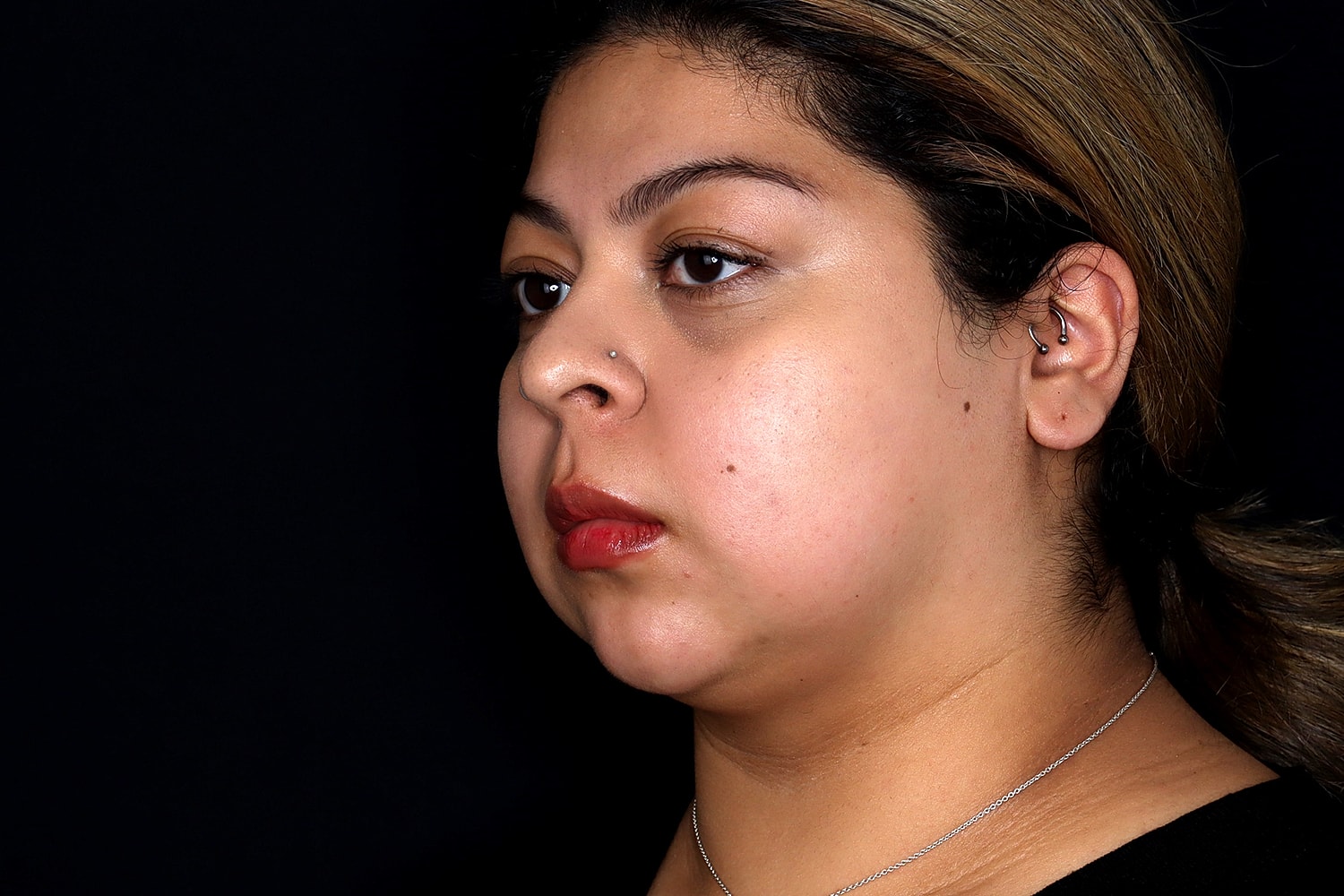 Chin Liposuction Before & After