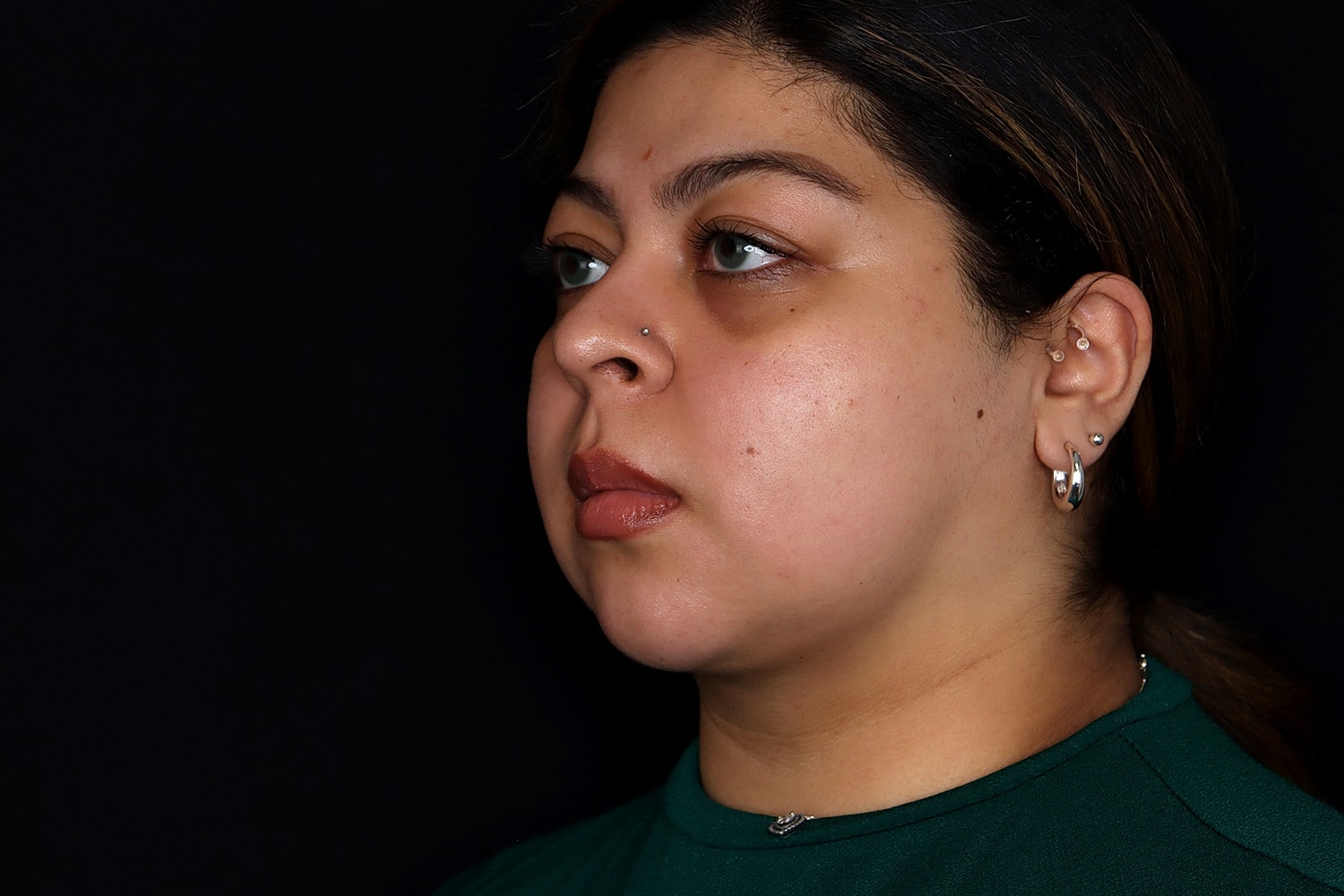 Chin Liposuction Before & After