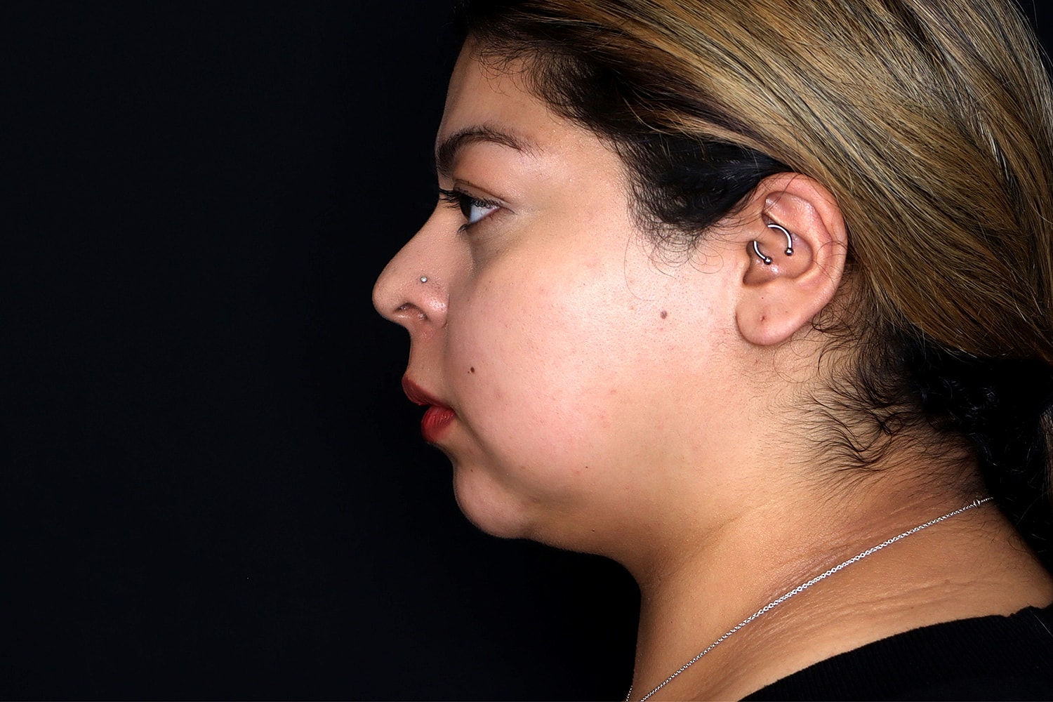 Chin Liposuction Before & After