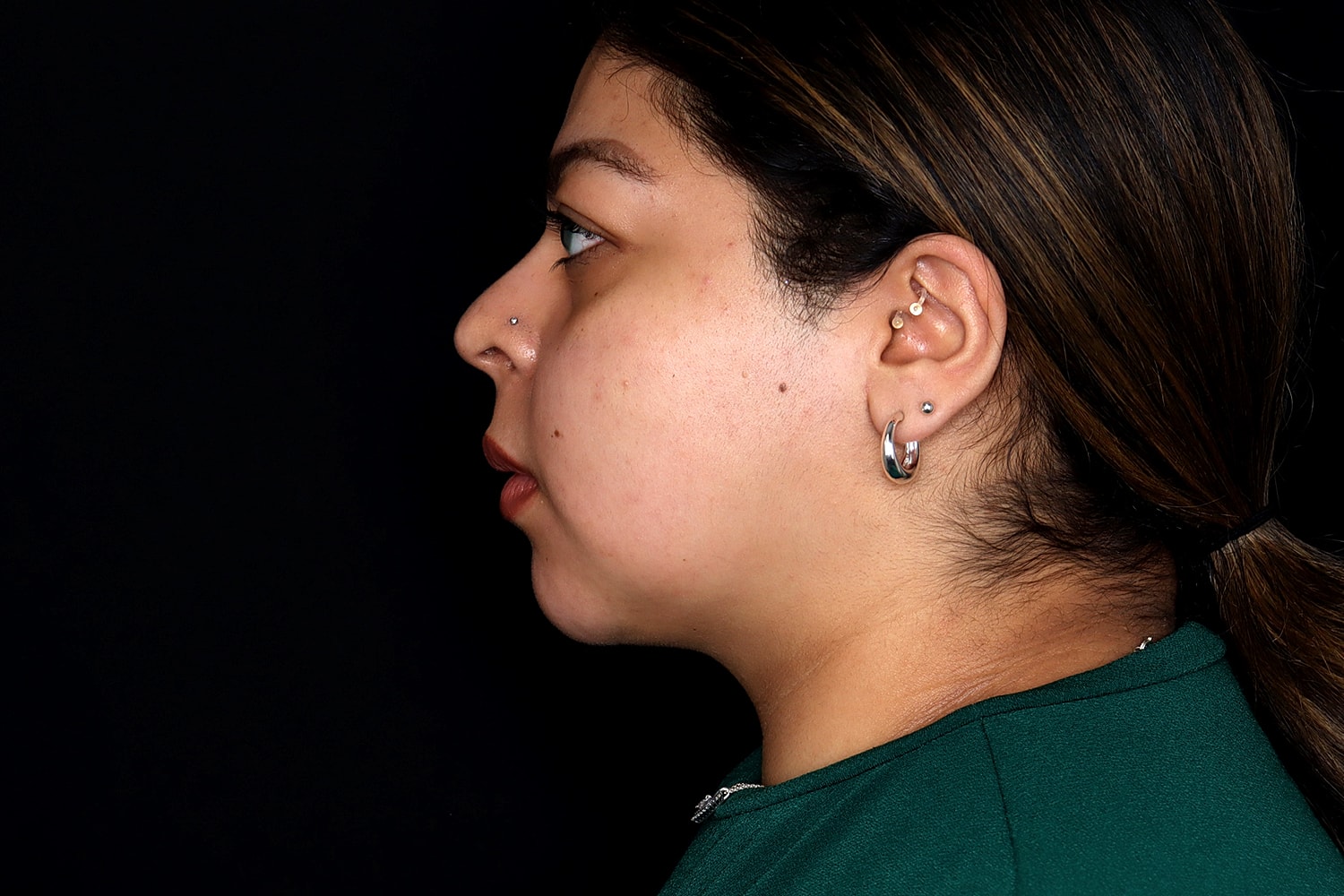 Chin Liposuction Before & After