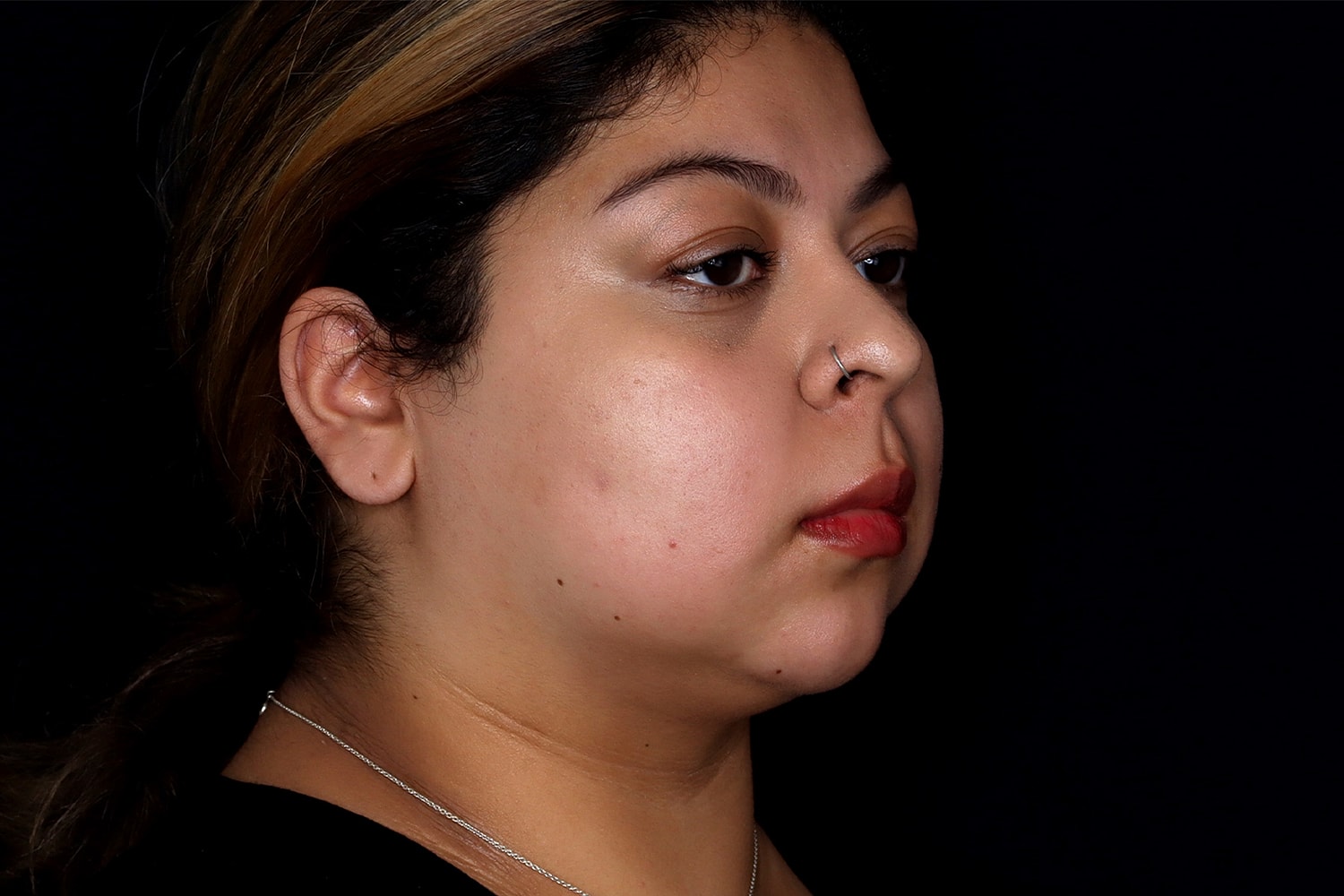 Chin Liposuction Before & After