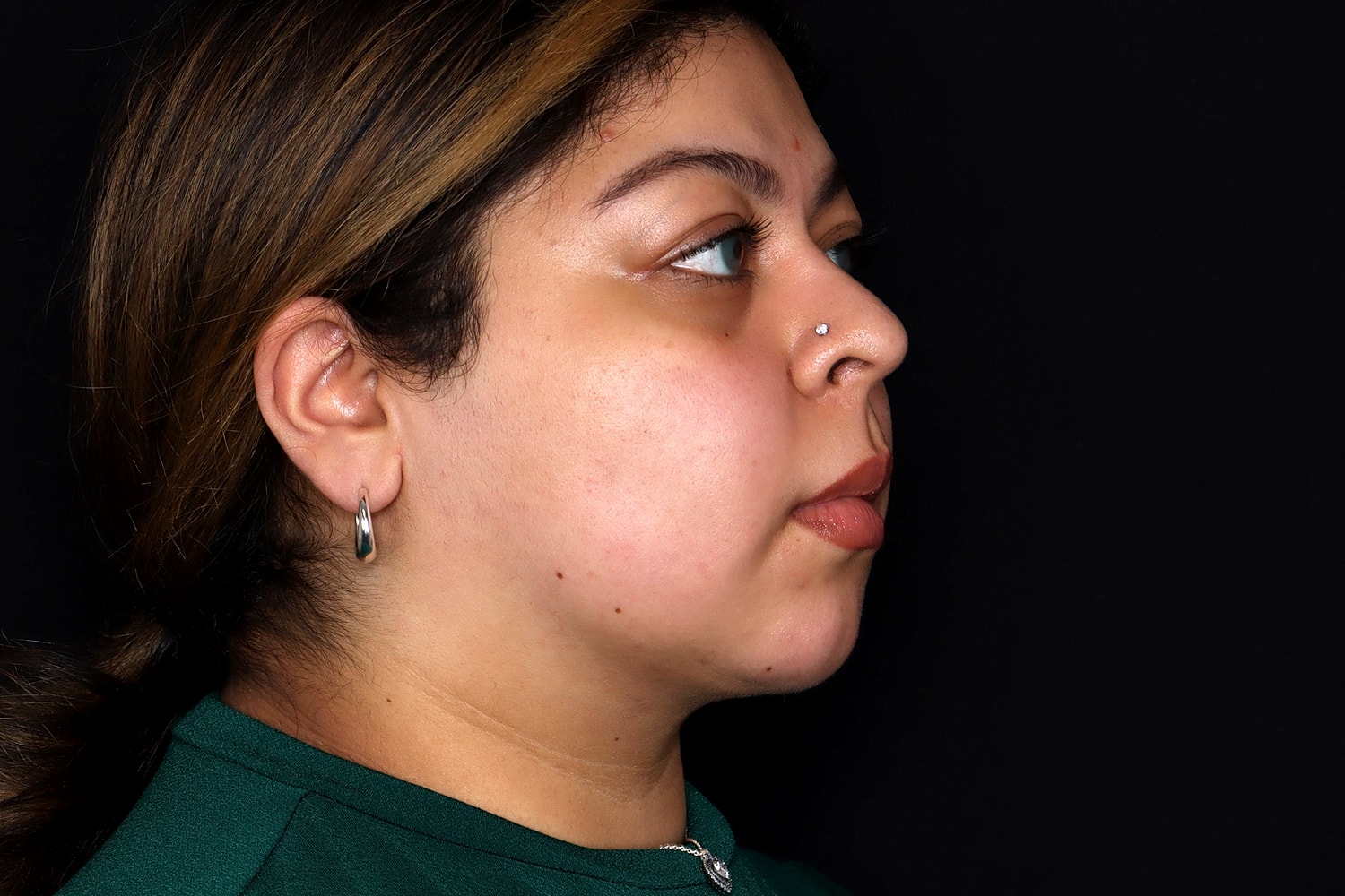 Chin Liposuction Before & After