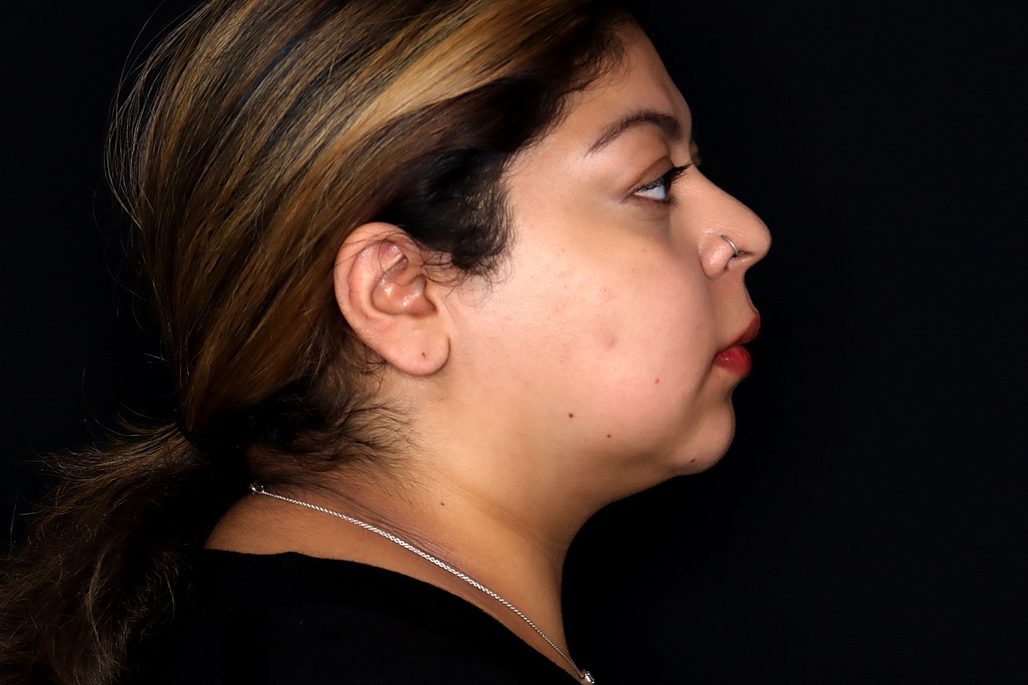 Chin Liposuction Before & After