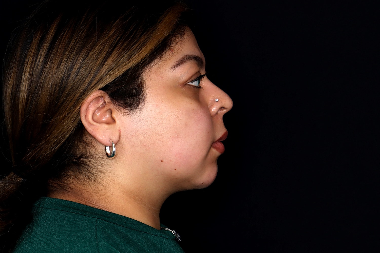 Chin Liposuction Before & After