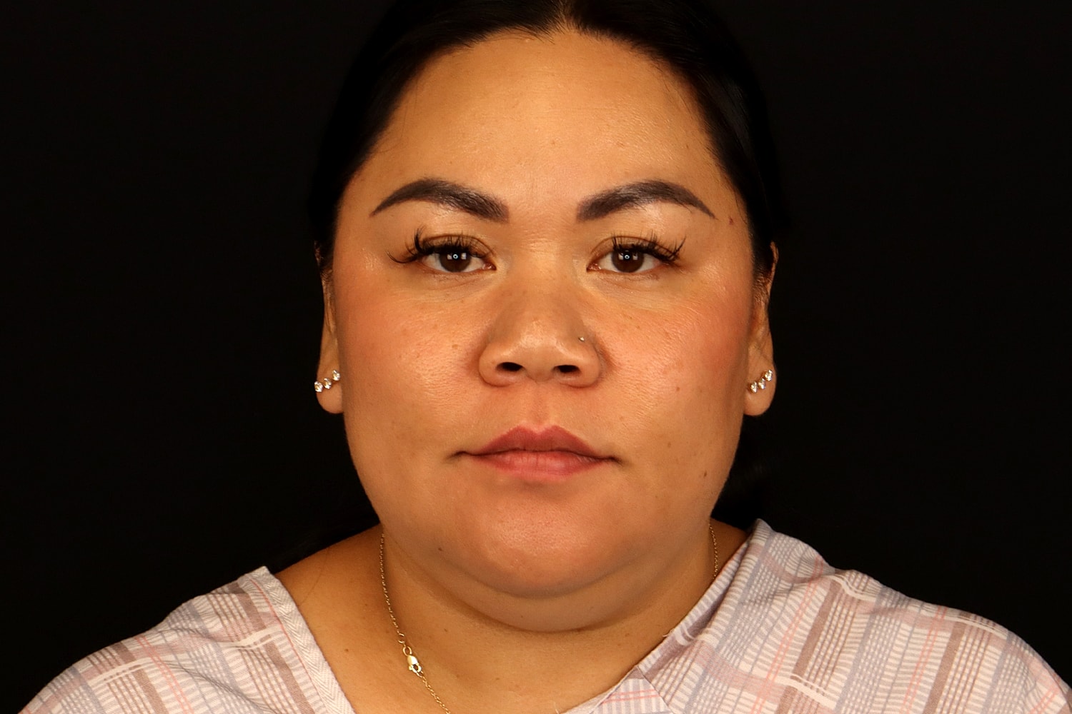 Chin Liposuction Before & After