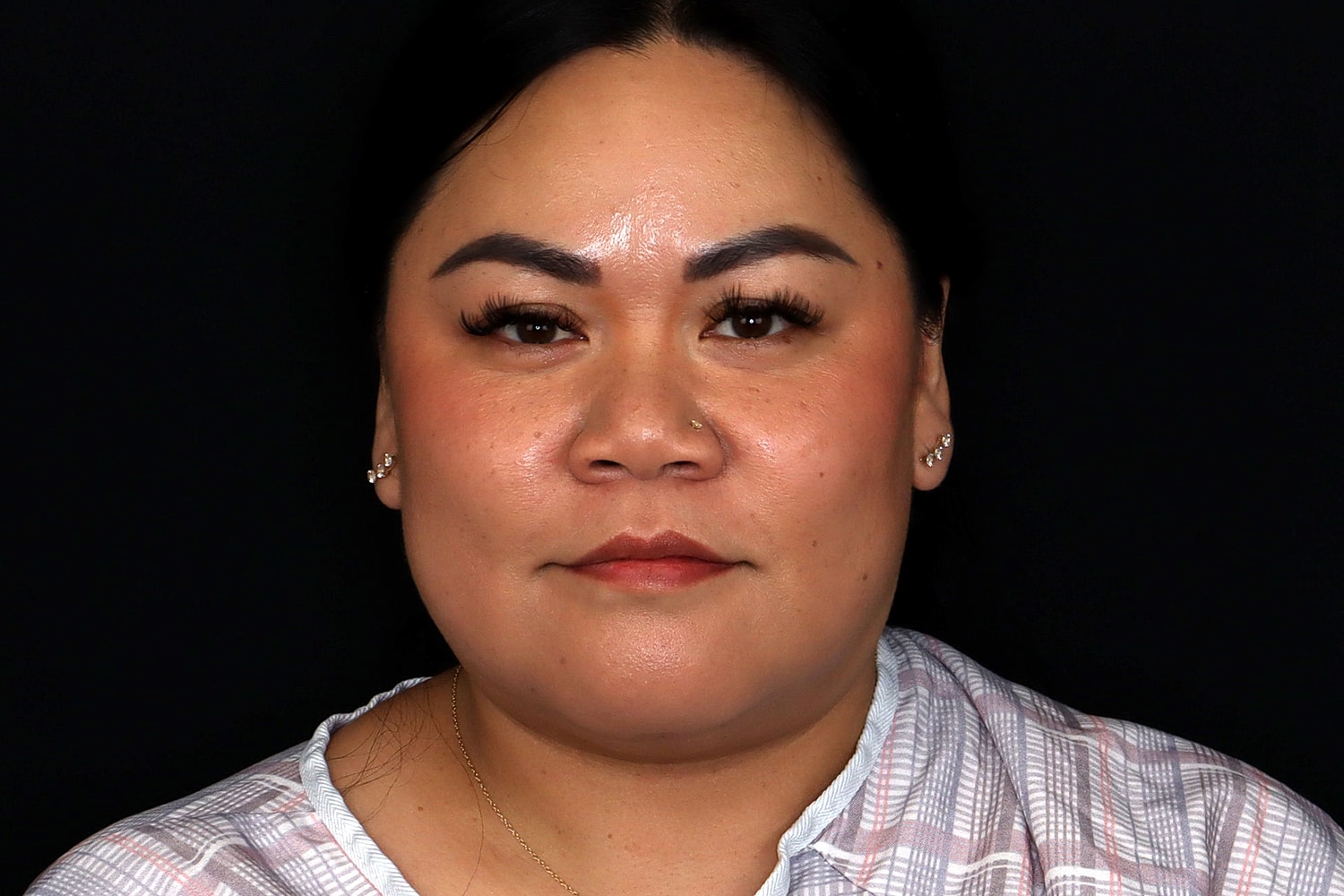 Chin Liposuction Before & After