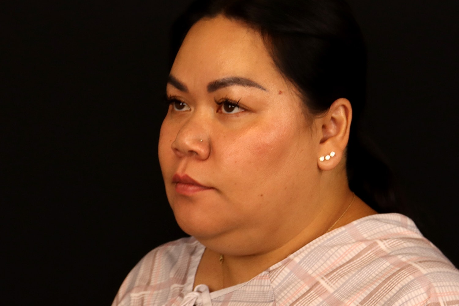 Chin Liposuction Before & After