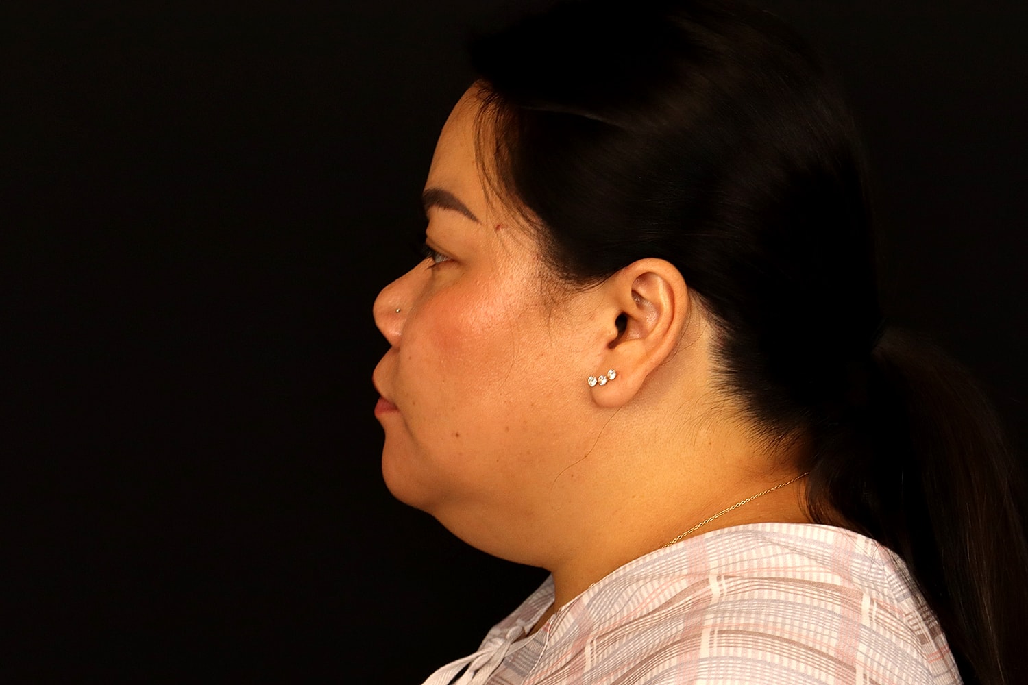 Chin Liposuction Before & After