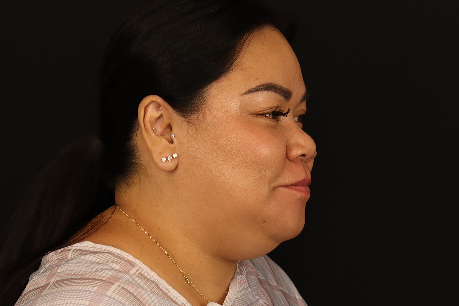 Chin Liposuction Before & After