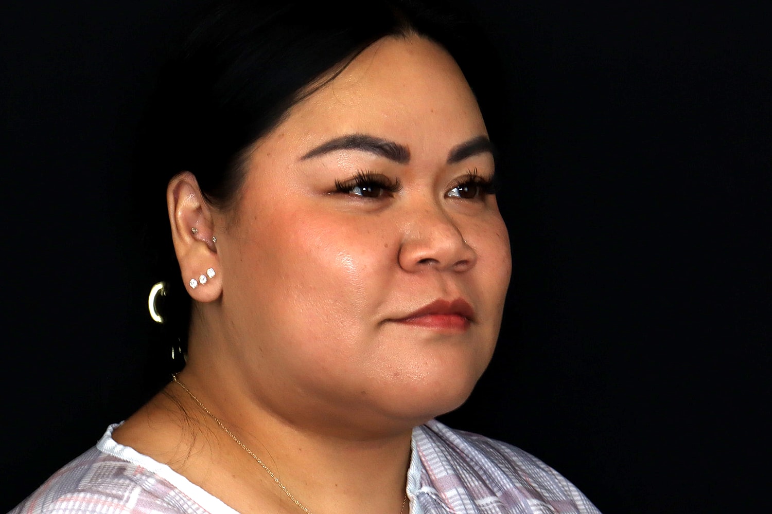 Chin Liposuction Before & After