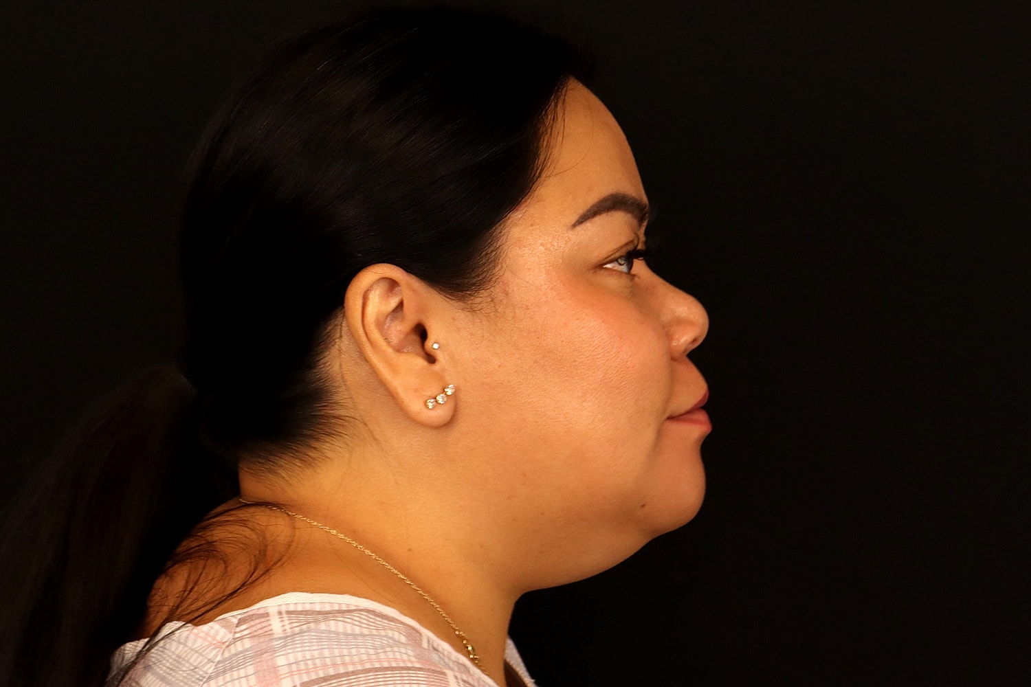 Chin Liposuction Before & After