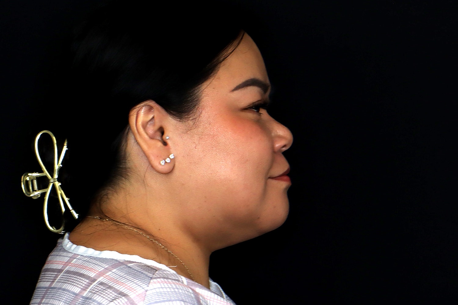 Chin Liposuction Before & After