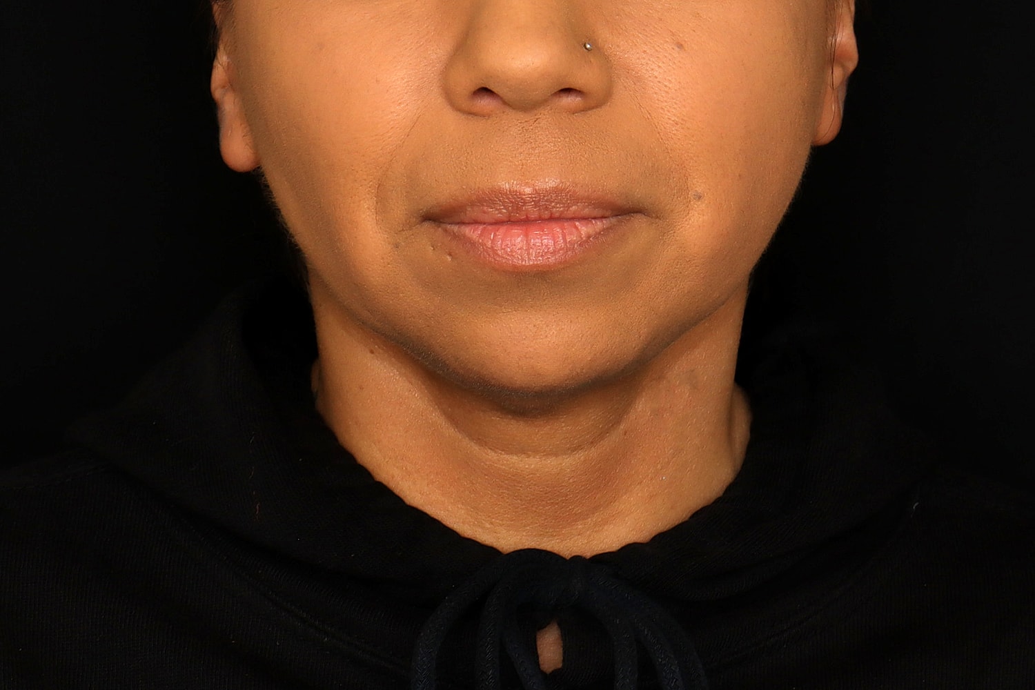 Chin Liposuction Before & After
