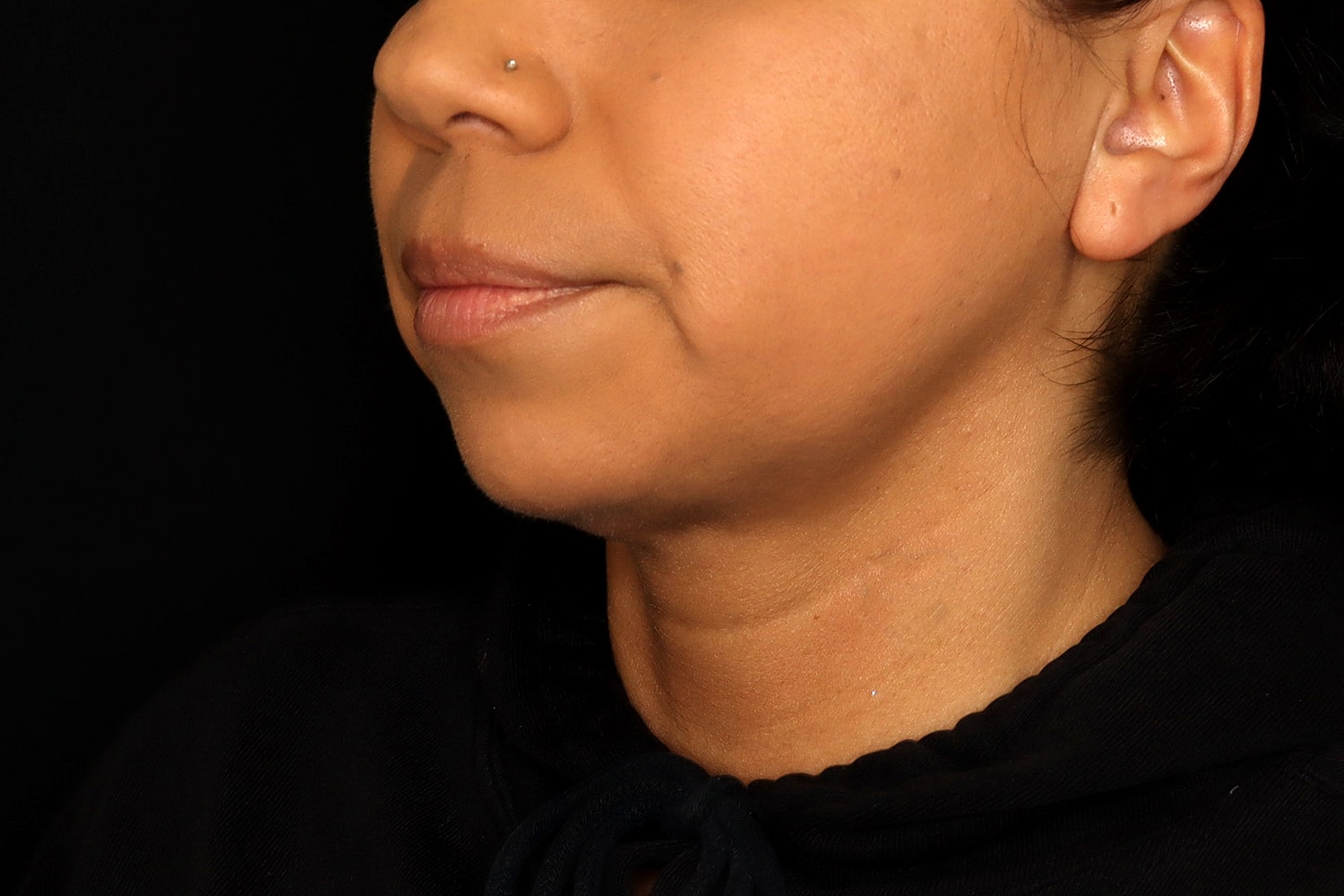 Chin Liposuction Before & After