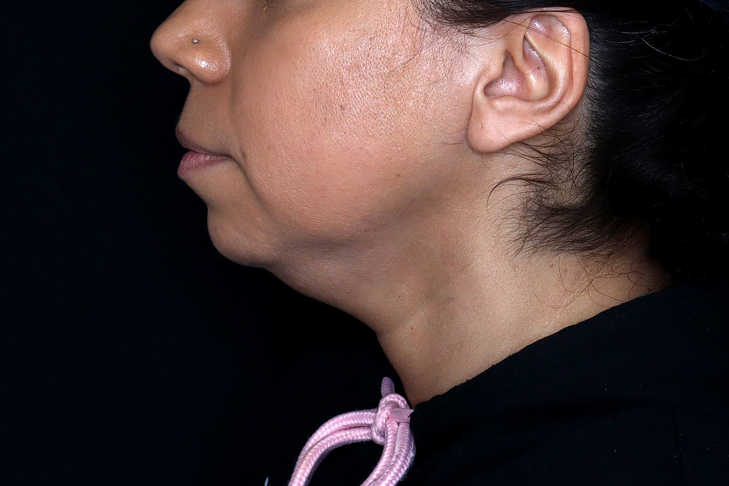 Chin Liposuction Before & After