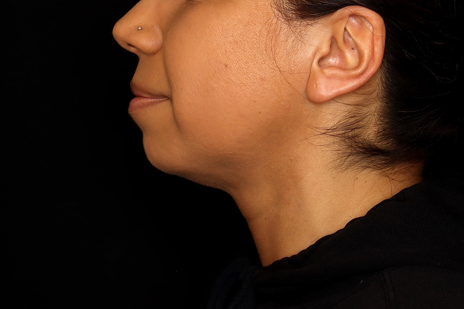Chin Liposuction Before & After