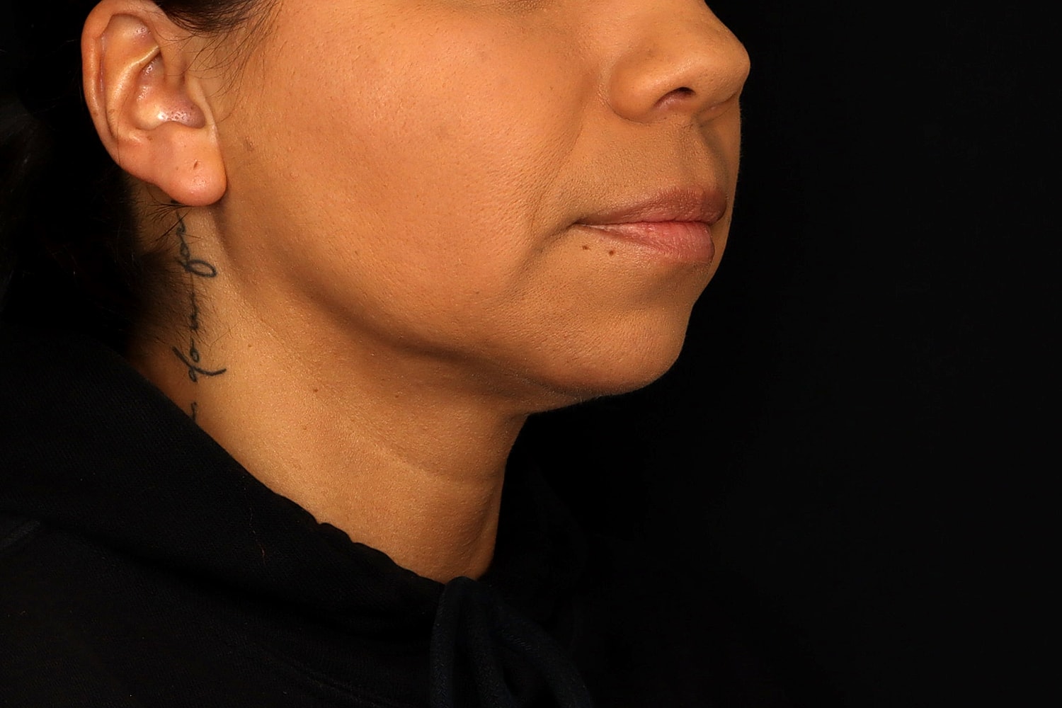 Chin Liposuction Before & After