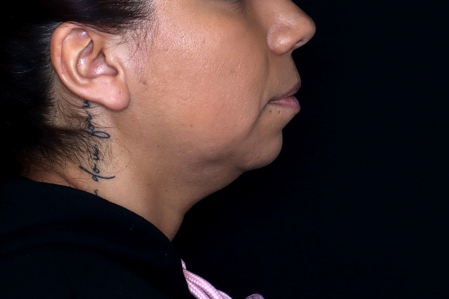 Chin Liposuction Before & After