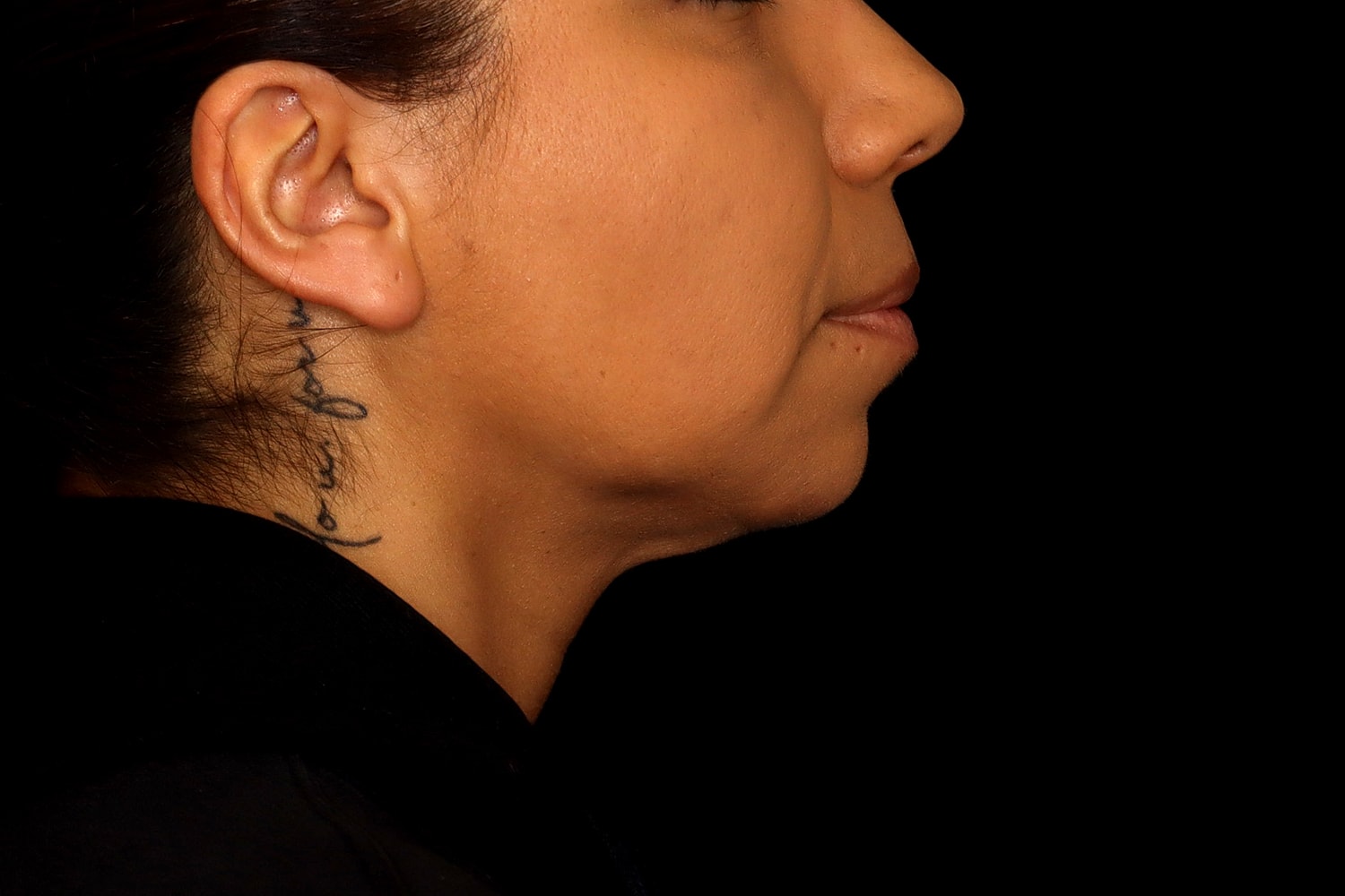 Chin Liposuction Before & After