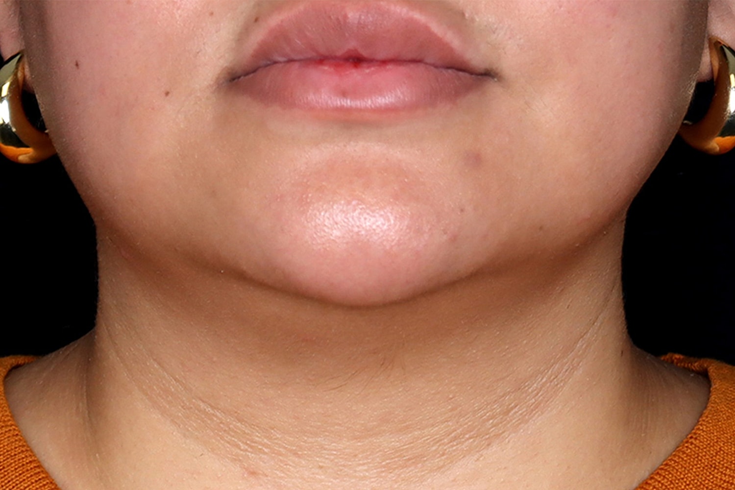 Chin Liposuction Before & After