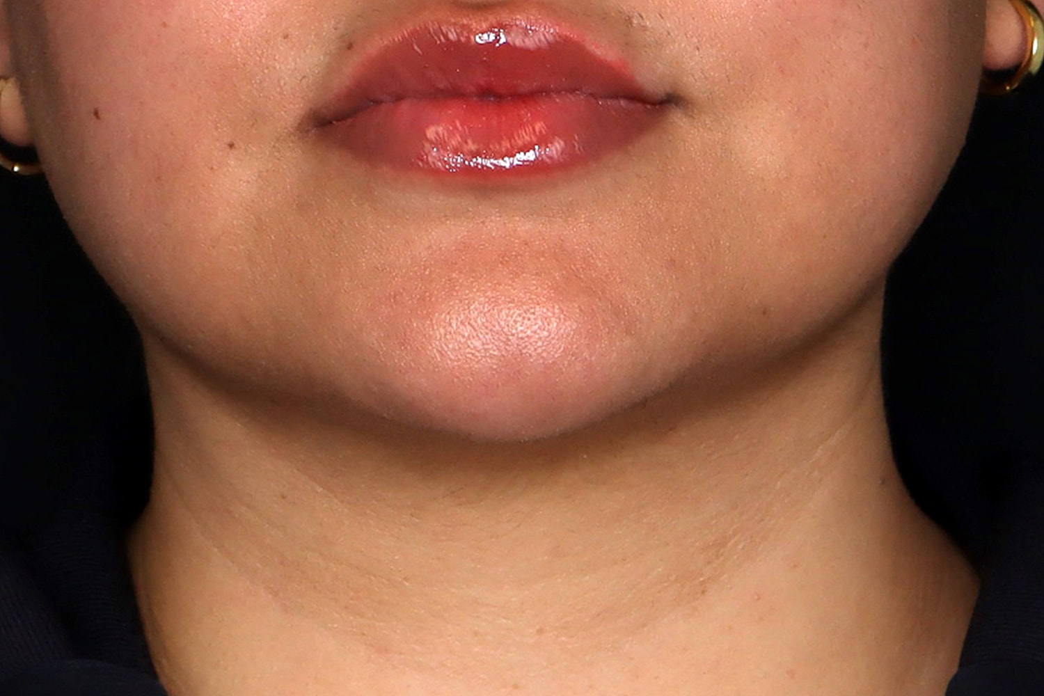 Chin Liposuction Before & After