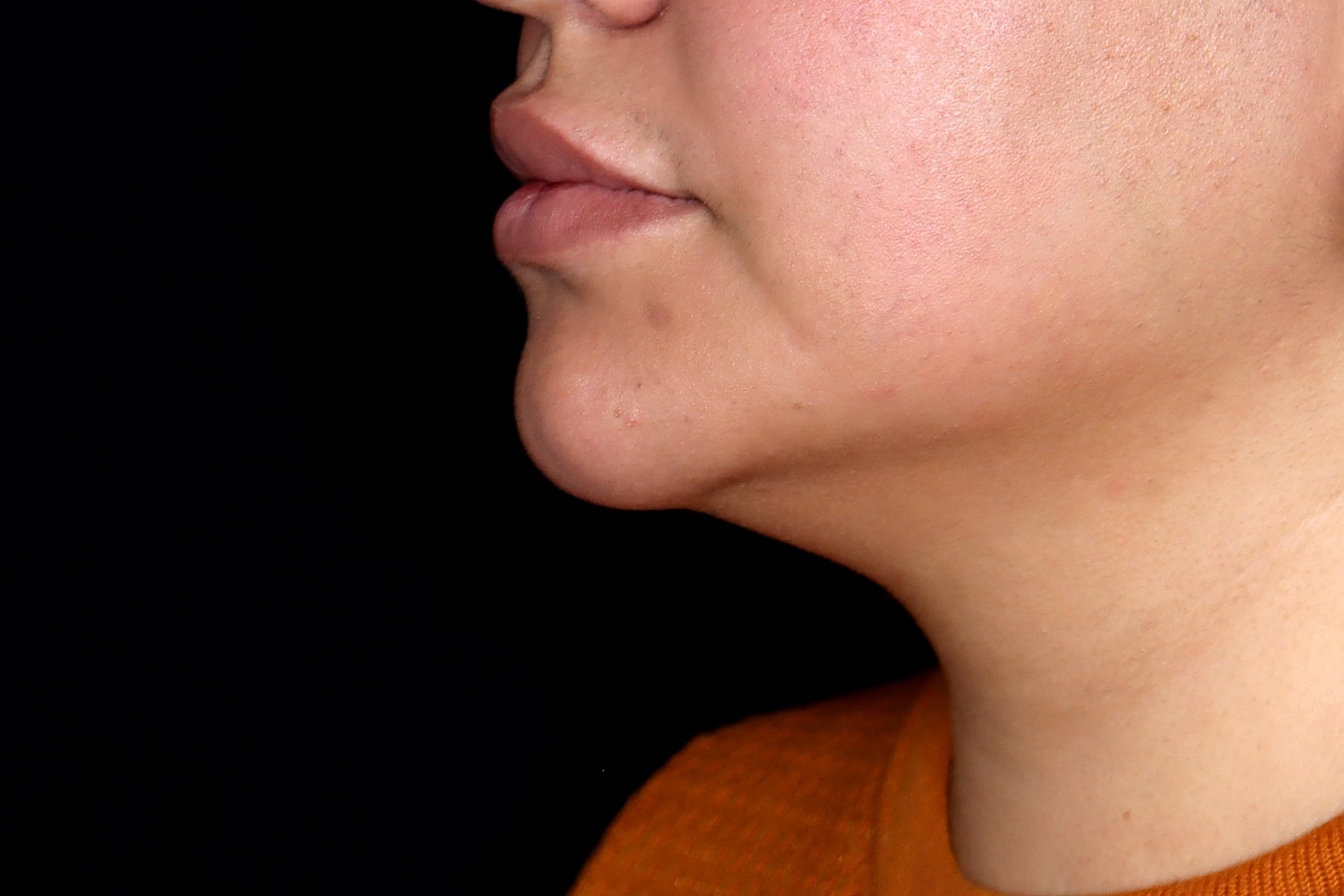 Chin Liposuction Before & After