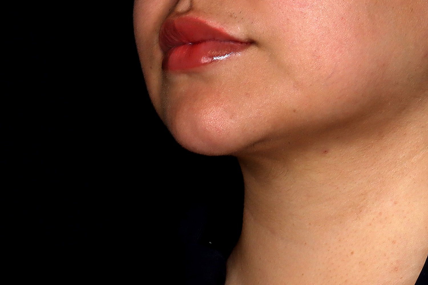 Chin Liposuction Before & After