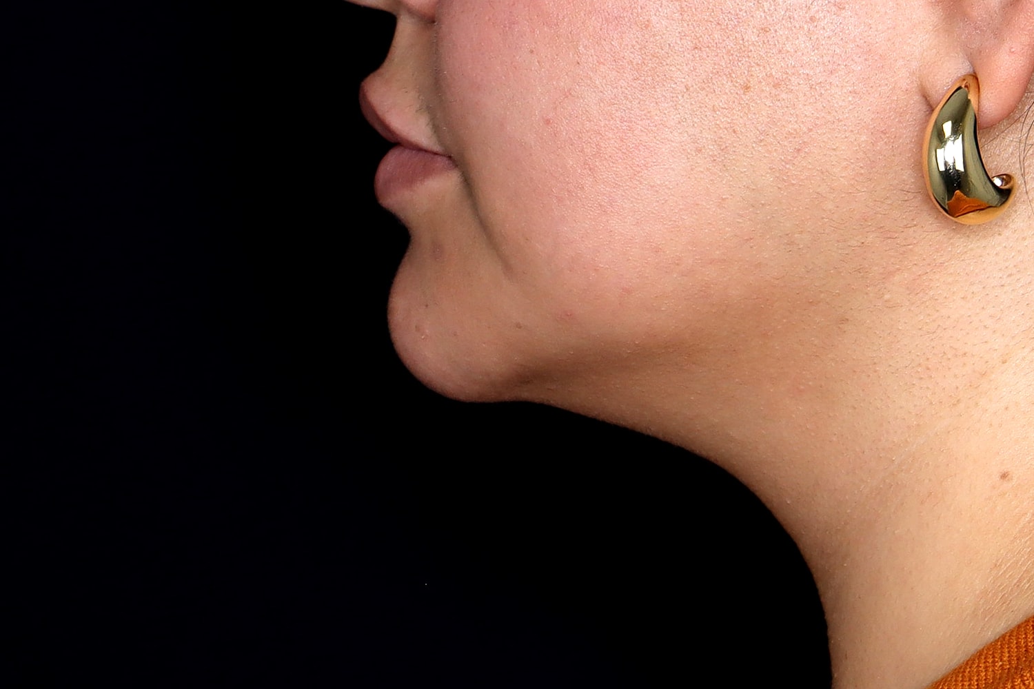 Chin Liposuction Before & After