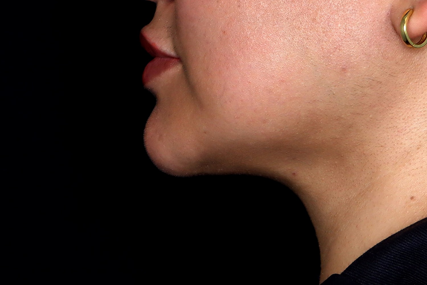 Chin Liposuction Before & After
