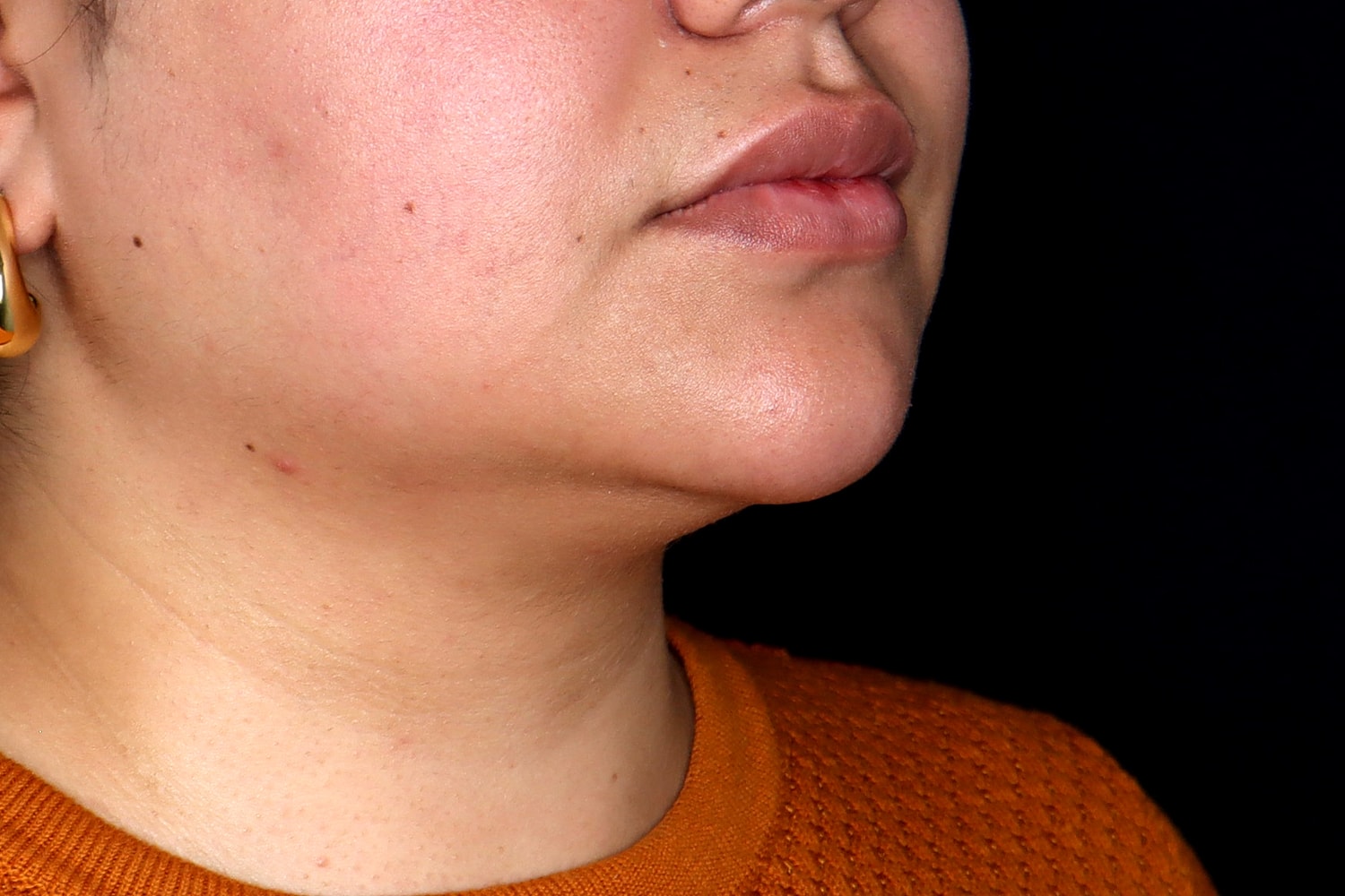 Chin Liposuction Before & After