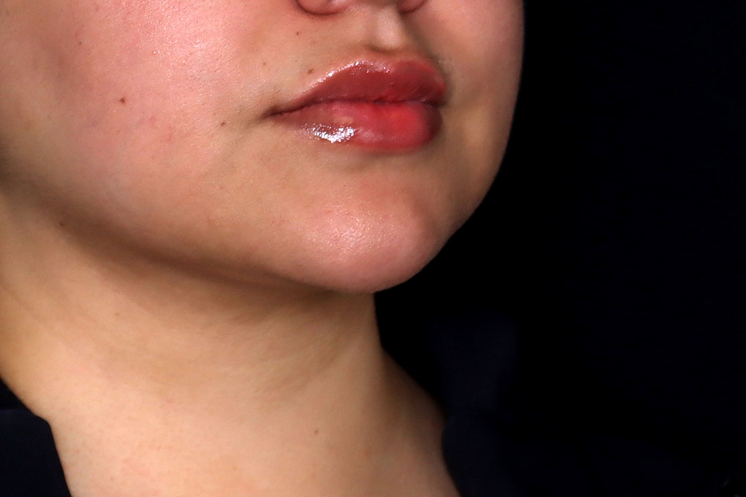 Chin Liposuction Before & After