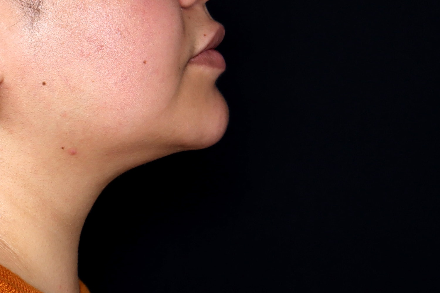 Chin Liposuction Before & After