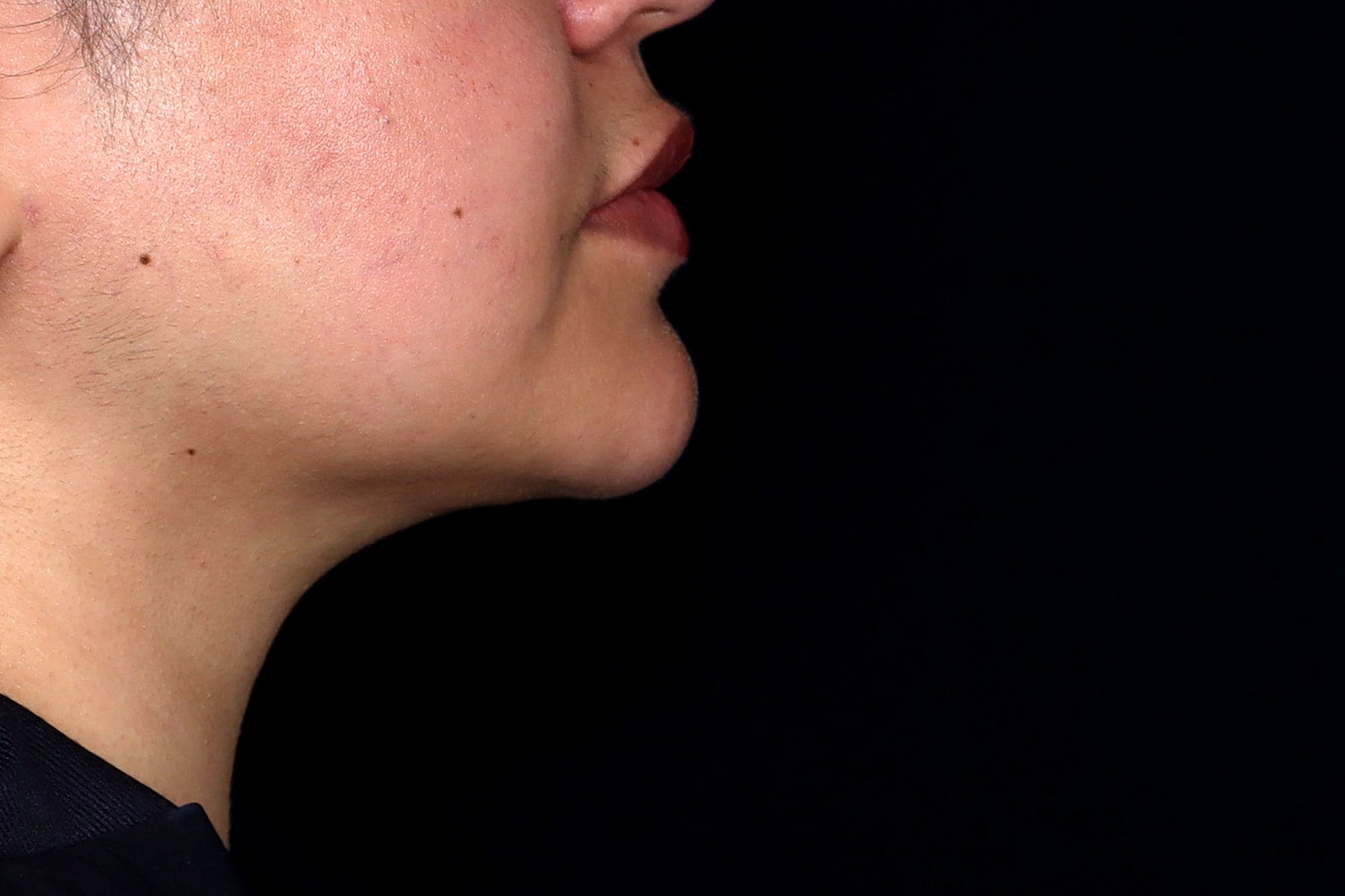 Chin Liposuction Before & After
