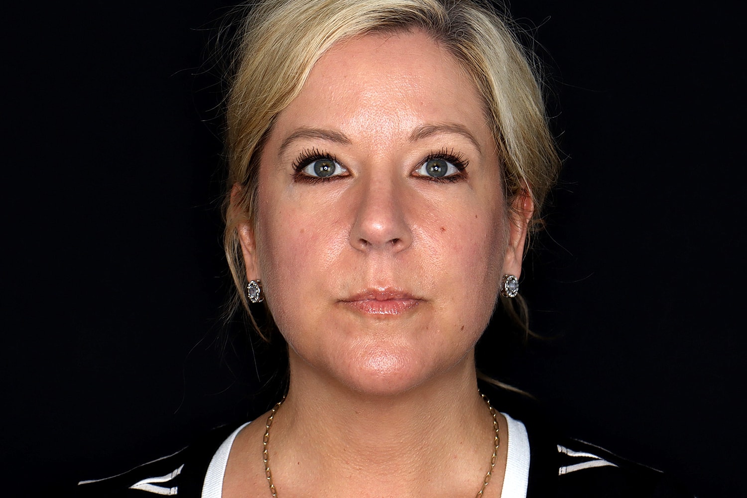 Chin Liposuction Before & After