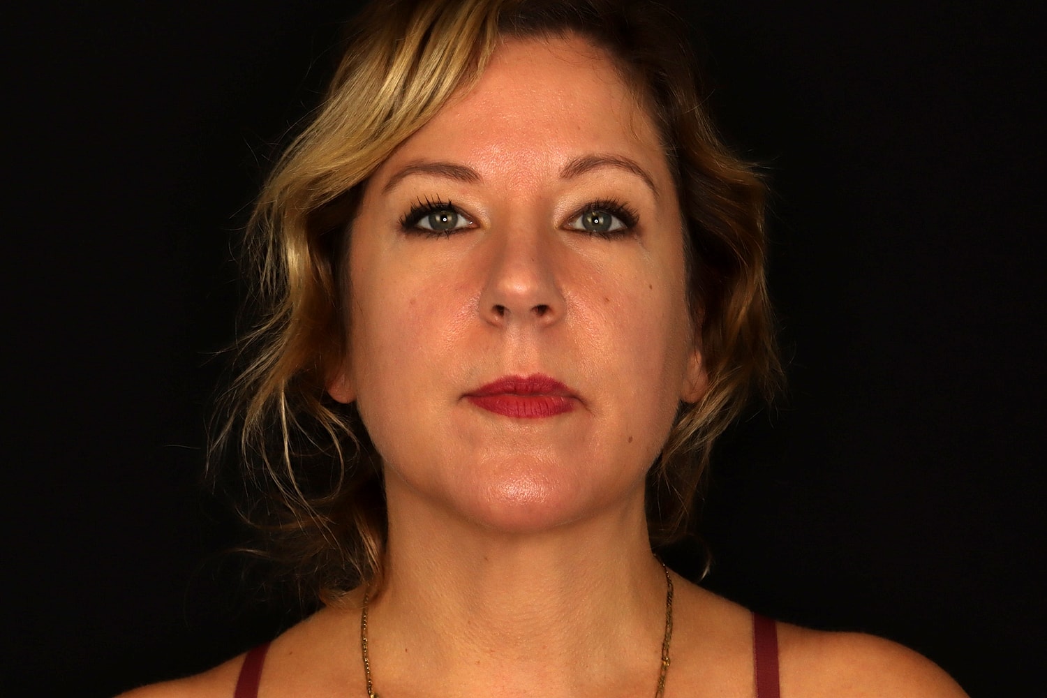 Chin Liposuction Before & After