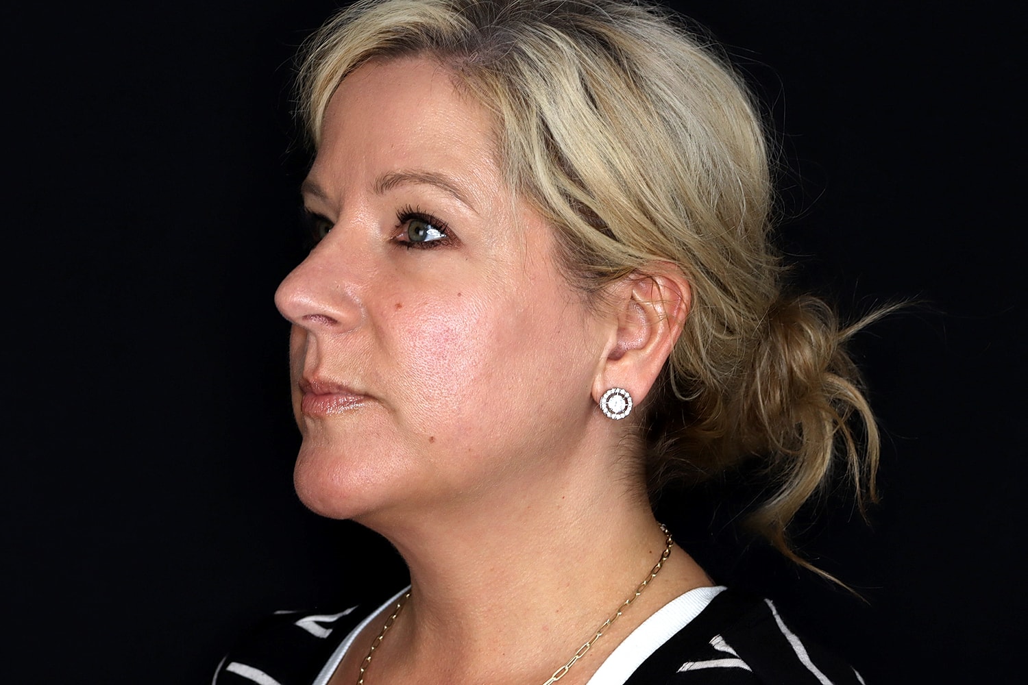 Chin Liposuction Before & After