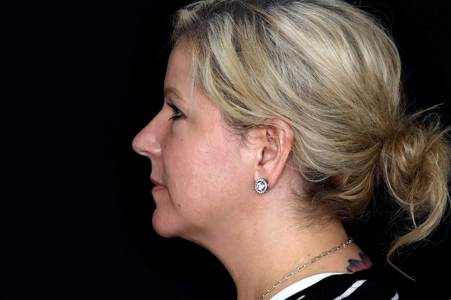 Chin Liposuction Before & After