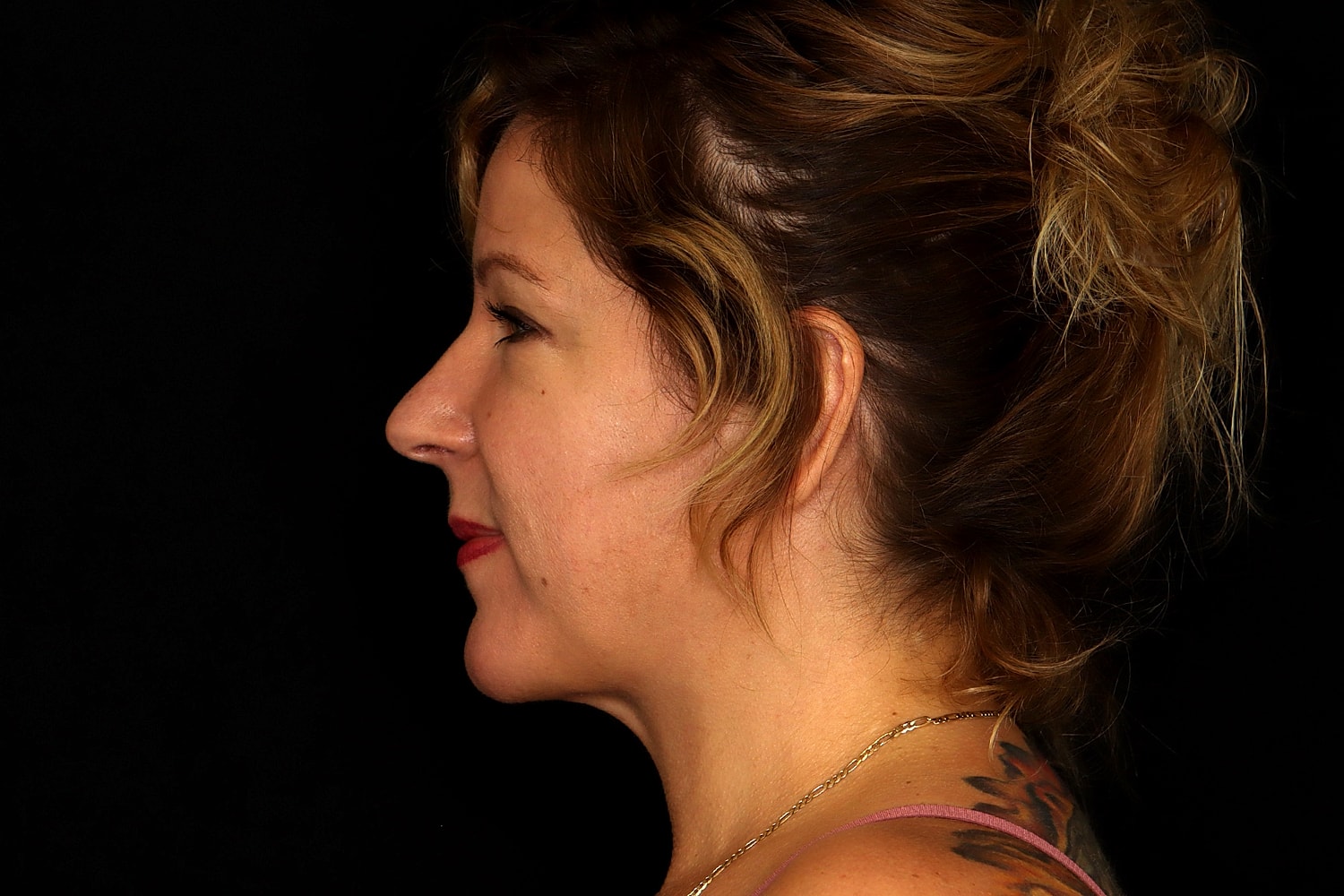 Chin Liposuction Before & After