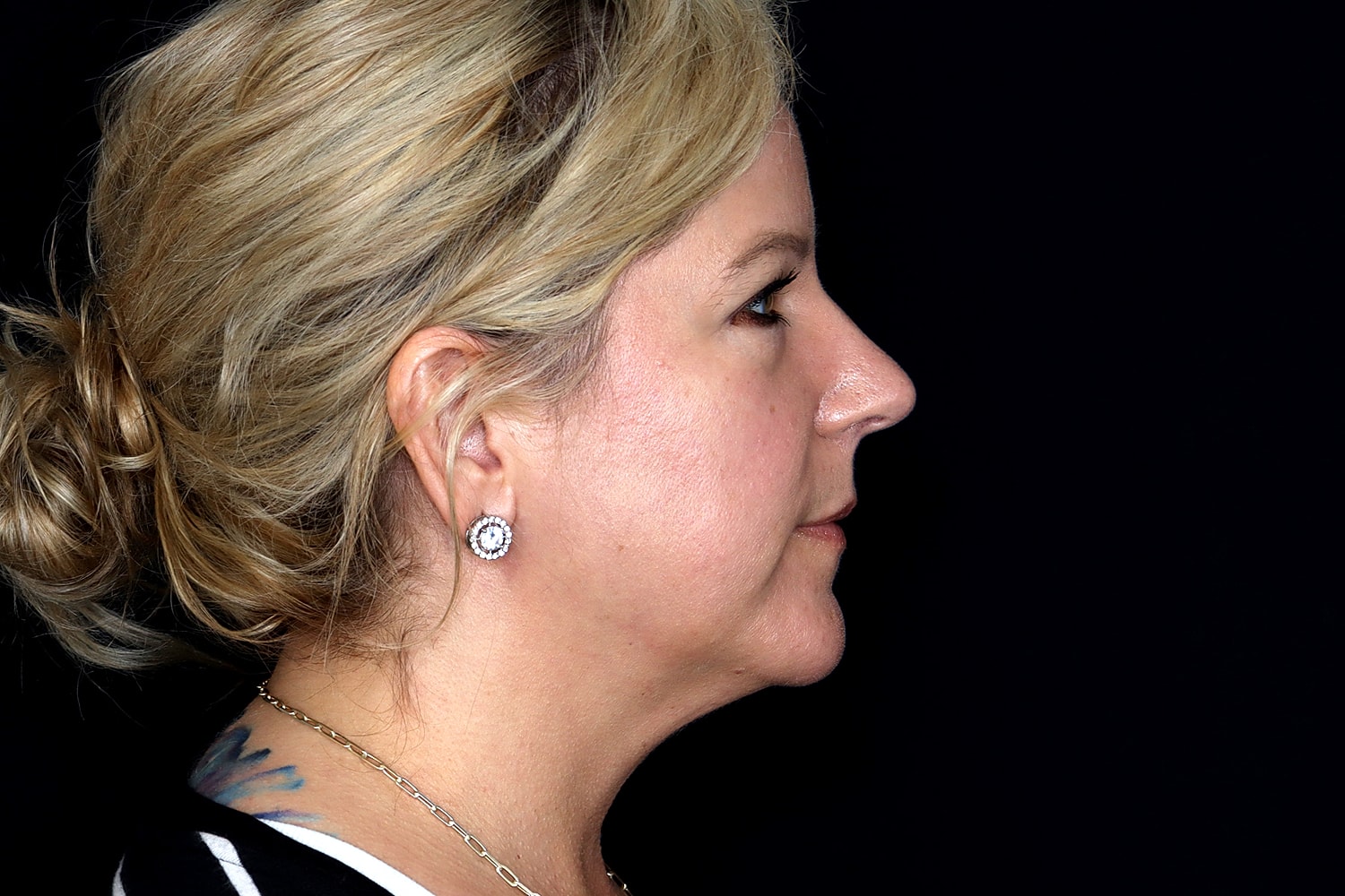 Chin Liposuction Before & After