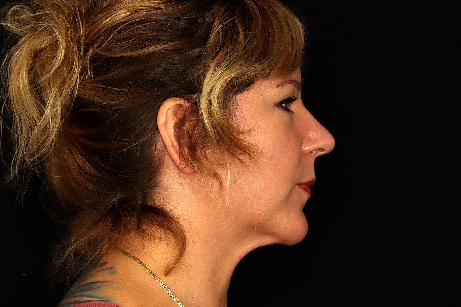 Chin Liposuction Before & After