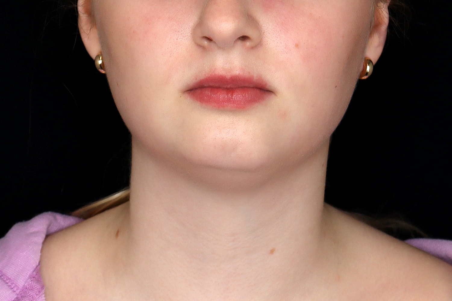 Chin Liposuction Before & After