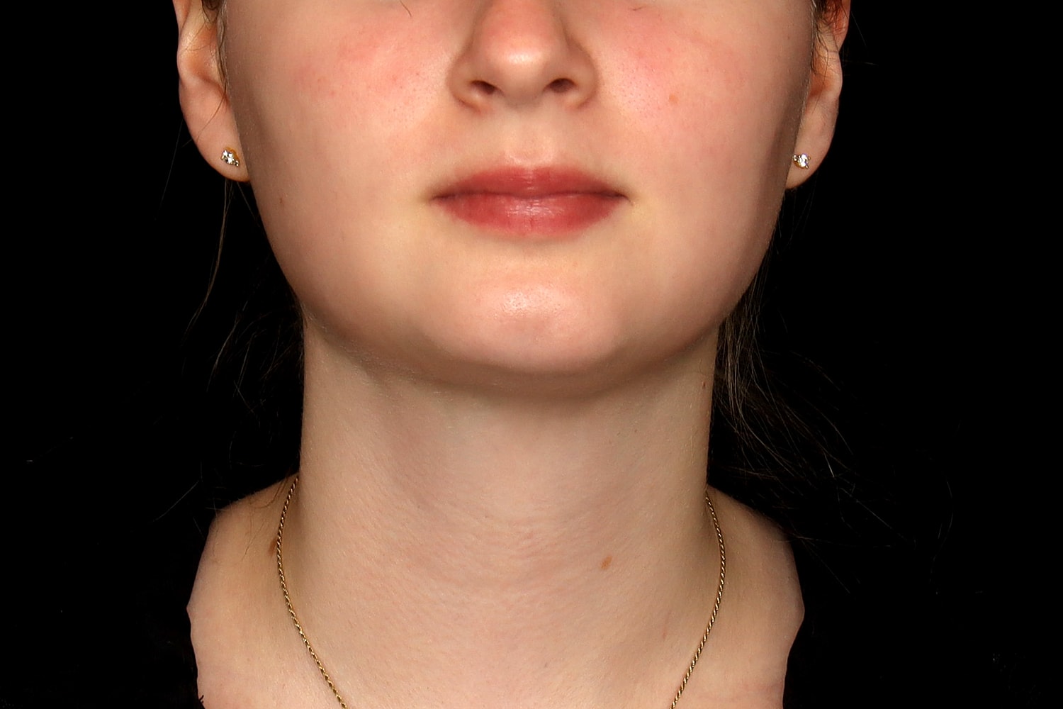 Chin Liposuction Before & After