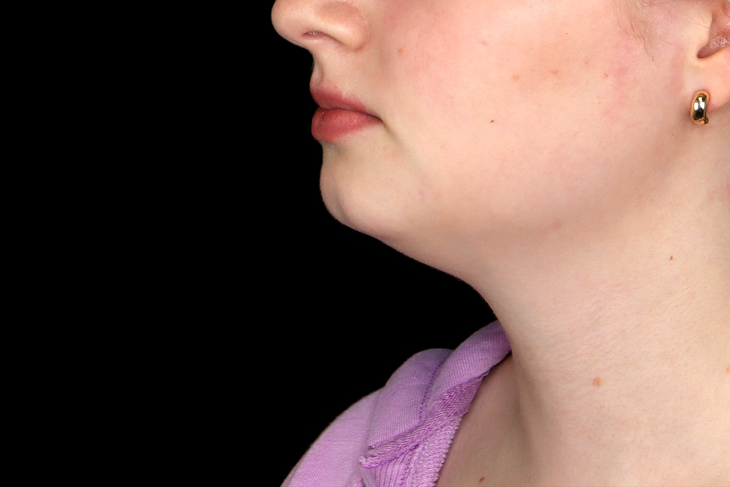 Chin Liposuction Before & After