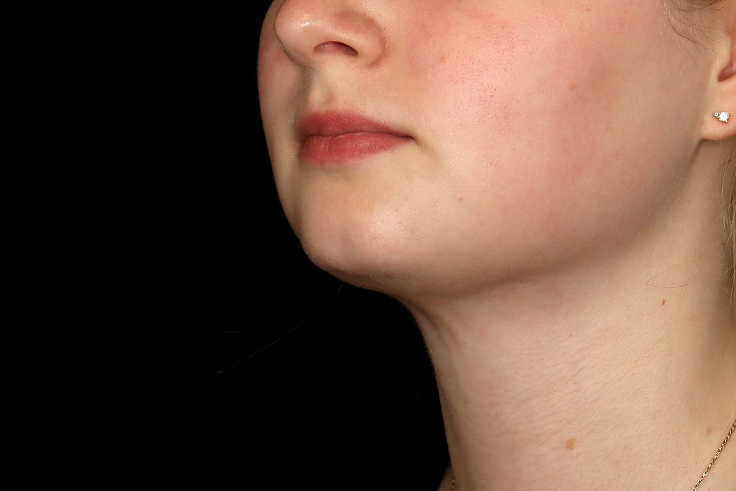 Chin Liposuction Before & After